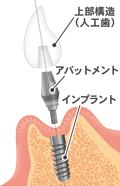 インプラントの構造（解説）