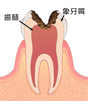 虫歯が神経にまで達した歯のイラスト