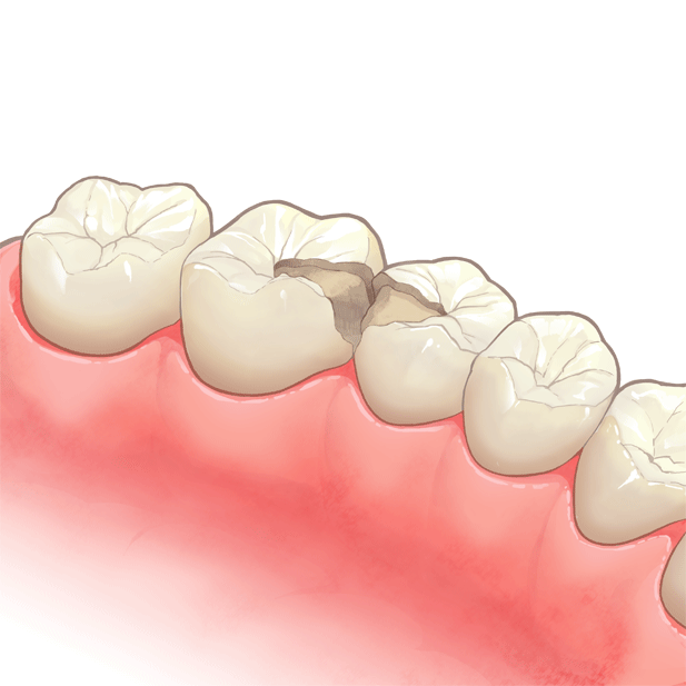 型取りされている奥歯のイラスト