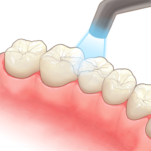 ライトで固められている奥歯のイラスト