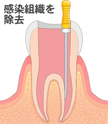 神経を取っている途中の歯のイラスト