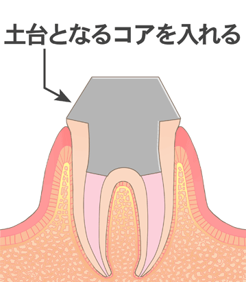 土台となるコアを入れられた歯のイラスト