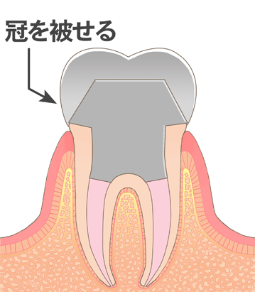 冠をかぶせられた歯のイラスト