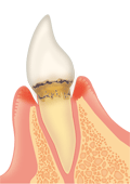 前歯の軽度歯周病