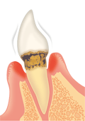 前歯の中度歯周病