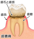 歯肉炎　文字あり