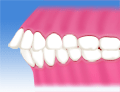 出っ歯・上顎前突