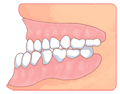 受け口・反対咬合・下顎前突 その２