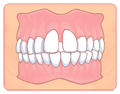 すきっ歯・空隙歯列 その２