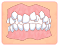 八重歯・乱ぐい歯・叢生 その２