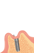 インプラント埋入後