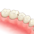 インレー（詰め物）の治療について