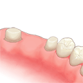 歯を削って土台に