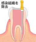 抜髄２　文字付