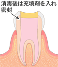 抜髄４　文字付