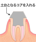 抜髄７　文字付