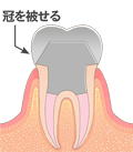 抜髄８　文字付