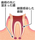 感染根管治療１　文字付