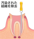 感染根管治療２　文字付