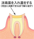 感染根管治療３　文字付