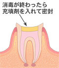 感染根管治療４　文字付