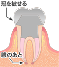 感染根管治療６　文字付