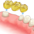 金ブリッジ装着