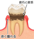 歯周病１　文字あり