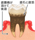 歯周病２　文字付