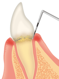 歯肉炎