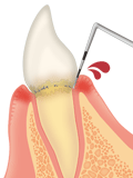 歯肉炎（出血有）