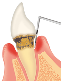 歯周炎