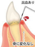 歯肉炎（出血有）　文字付