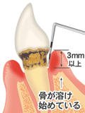 歯周炎　文字付