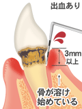 歯周炎（出血有）　文字付